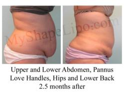large volume liposuction, liposuction of abdomen, liposuction before and after